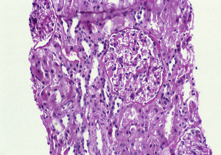 Mesangial proliferative lupus nephritis ISN/RPS class II with mild mesangial proliferation without endocapillary hypercellularity or glomerular scarring related to lupus nephritis (periodic acid–Schiff stain). Reproduced with permission from AJKD 32(1):e1-e2.1.