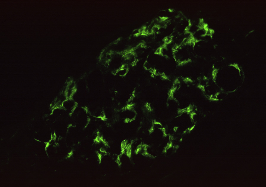 Mesangial proliferative lupus nephritis ISN/RPS class II with granular mesangial without capillary loop staining (immunofluorescence microscopy, IgM). Reproduced with permission from AJKD 32(1):e1-e2.1.