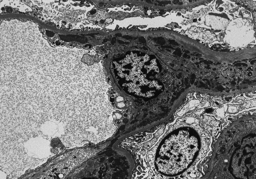 Mesangial proliferative lupus nephritis ISN/RPS class II with mesangial deposits (electron microscopy). Reproduced with permission from AJKD 32(1):e1-e2.1.