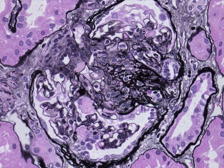 Nail-patella–like renal disease (also known as LMX1B-associated nephropathy) with segmental glomerulosclerosis in a 39-year-old man with dystrophic nails, but no patellar or other skeletal abnormalities (Jones silver stain).