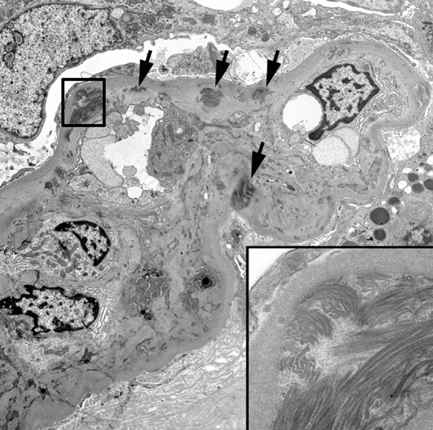 Electron microscopy of nail-patella-like renal disease (also know as LMX1B-associated nephropathy) with scattered deposition of fibrillar collagen in glomerular basement membranes and mesangial matrix (arrows); inset: magnified view of collagen fibrils, some of which have curved appearance.