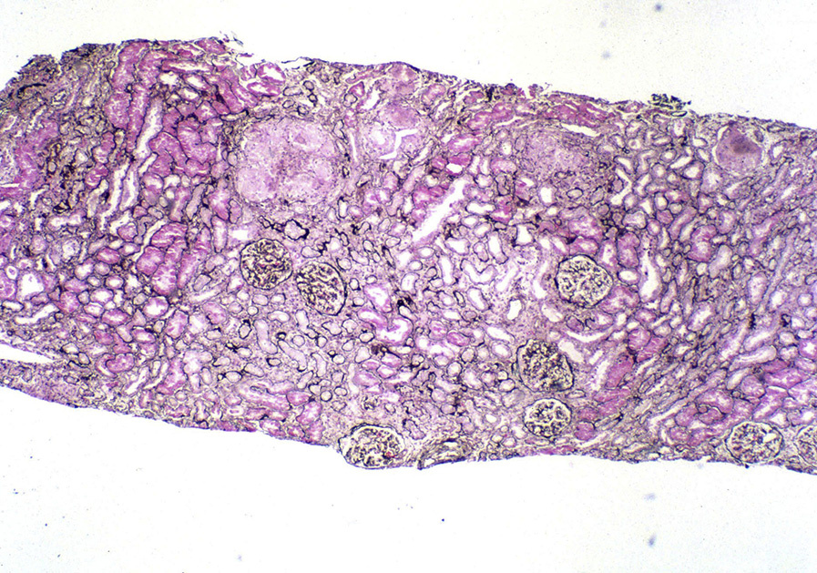 Sarcoidosis in the kidney is characterized by sharply delineated nonnecrotizing granulomas with frequent epithelioidtype multinucleated giant cells with associated interstitial fibrosis and lymphoplasmacytic interstitial infiltrate (Jones stain). Reproduced with permission from AJKD 37(2):e12-e13.