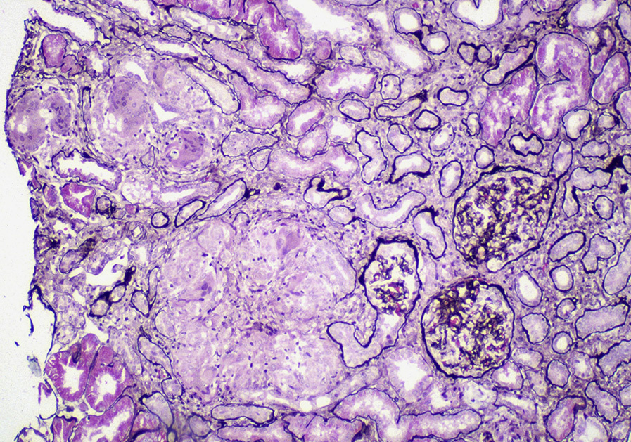 Sarcoidosis in the kidney with well-delineated nonnecrotizing granulomas with adjacent tubulointerstitial fibrosis (Jones stain). Reproduced with permission from AJKD 37(2):e12-e13.