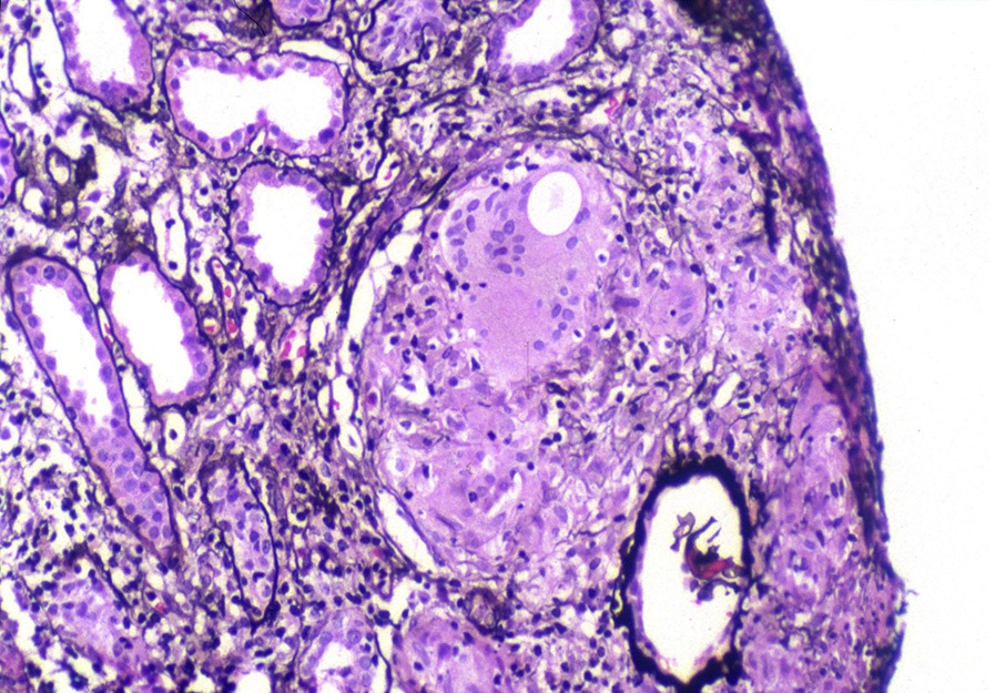 Sarcoidosis in the kidney with nonnecrotizing granulomas comprising large giant cells with surrounding lymphoplasmacytic interstitial infiltrate and early tubulointerstitial fibrosis (Jones stain). Reproduced with permission from AJKD 37(2):e12-e13.