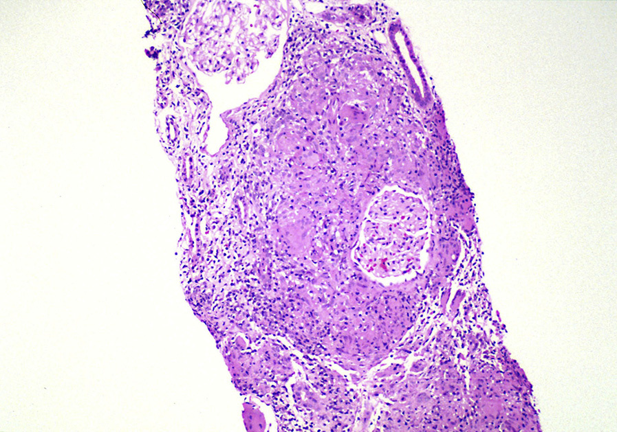 Sarcoidosis in the kidney with well-delineated granuloma with numerous giant cells surrounding an intact glomerulus (hematoxylin and eosin stain). Reproduced with permission from AJKD 37(2):e12-e13.