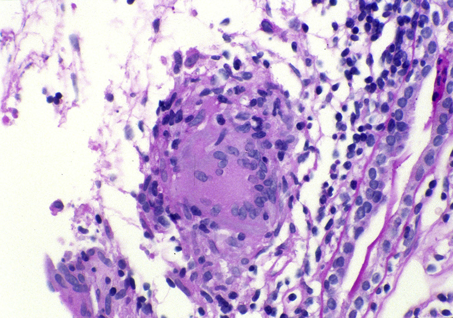 Sarcoidosis in the kidney, with multinucleated giant cells (periodic acid–Schiff stain). Reproduced with permission from AJKD 37(2):e12-e13.